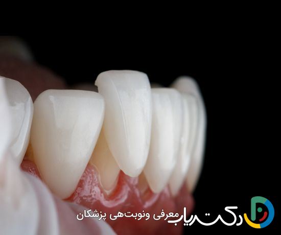 روکش تمام سرامیک چیست؟ (ایمکس با فناوری CAD/CAM)