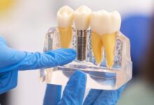 تفاوت بین متخصص ایمپلنت (ایمپلنتولوژیست) و دندانپزشک عمومی چیست؟