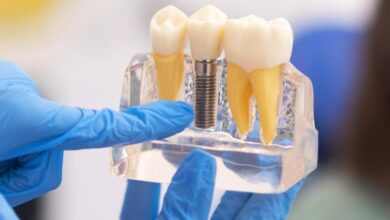 تفاوت بین متخصص ایمپلنت (ایمپلنتولوژیست) و دندانپزشک عمومی چیست؟