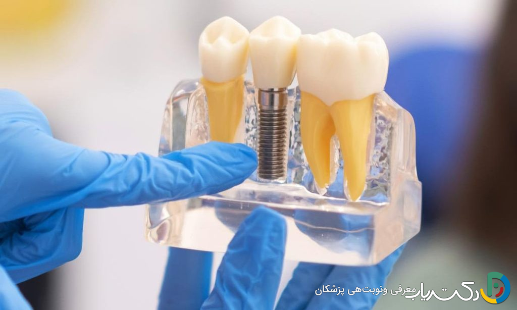 تفاوت بین متخصص ایمپلنت (ایمپلنتولوژیست) و دندانپزشک عمومی چیست؟