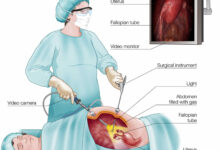 فرق عمل لاپاراسکوپی با عمل باز (لاپاراتومی) چیست؟