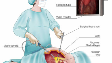 فرق عمل لاپاراسکوپی با عمل باز (لاپاراتومی) چیست؟