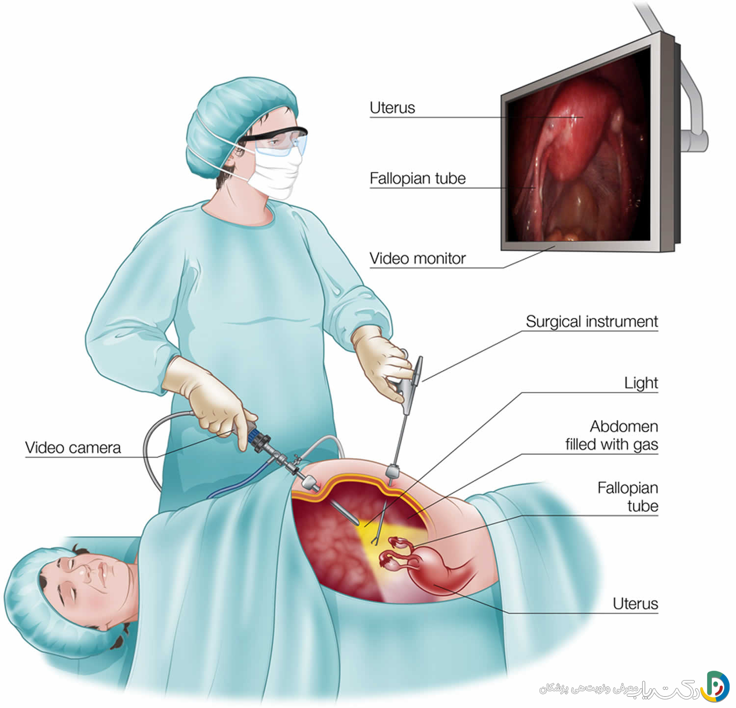 فرق عمل لاپاراسکوپی با عمل باز (لاپاراتومی) چیست؟