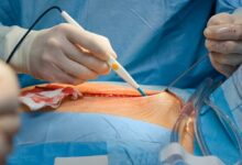 عمل میومکتومی باز (لاپاراتومی) چگونه است؟