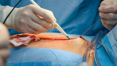 عمل میومکتومی باز (لاپاراتومی) چگونه است؟