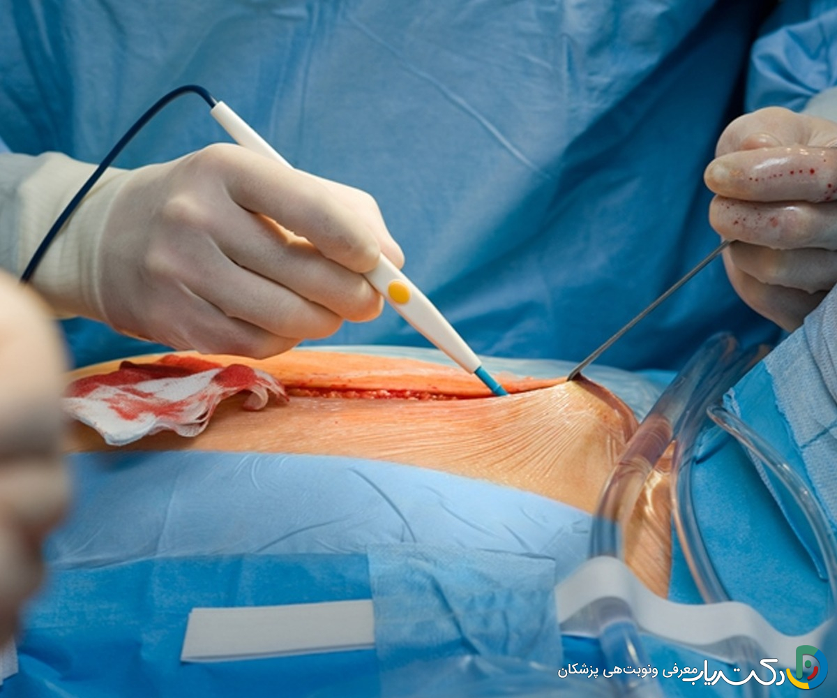 عمل میومکتومی باز (لاپاراتومی) چگونه است؟