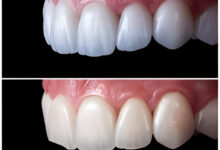 کدام روش کمترین تراش را دارد؟ لمینت یا کامپوزیت؟