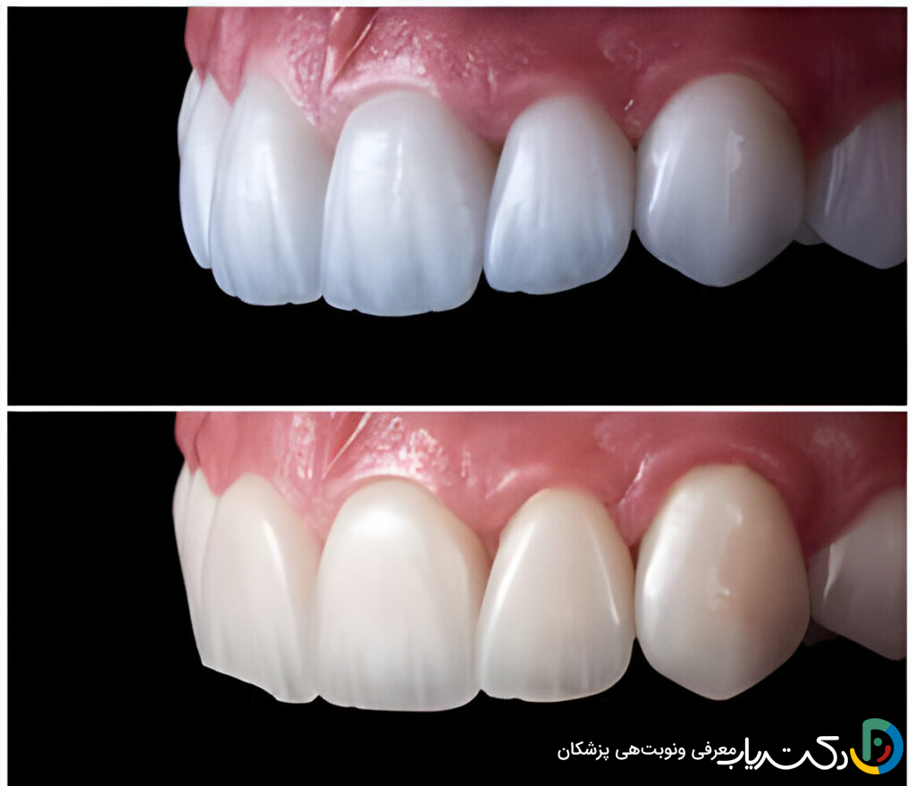 کدام روش کمترین تراش را دارد؟ لمینت یا کامپوزیت؟