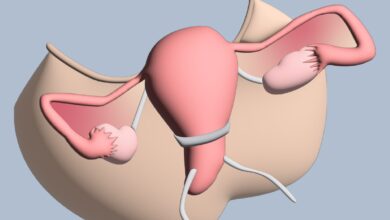 سرکلاژ شکمی (ترانس ابدومینال) چیست و برای چه کسانی است؟