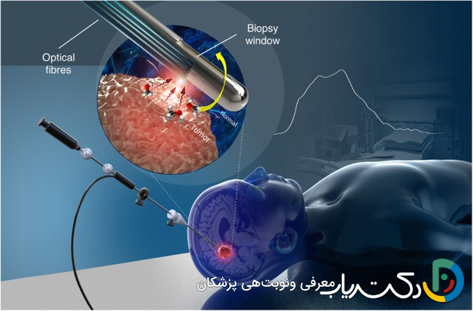 گریدبندی تومور مغزی چیست و چگونه تعیین می‌شود؟