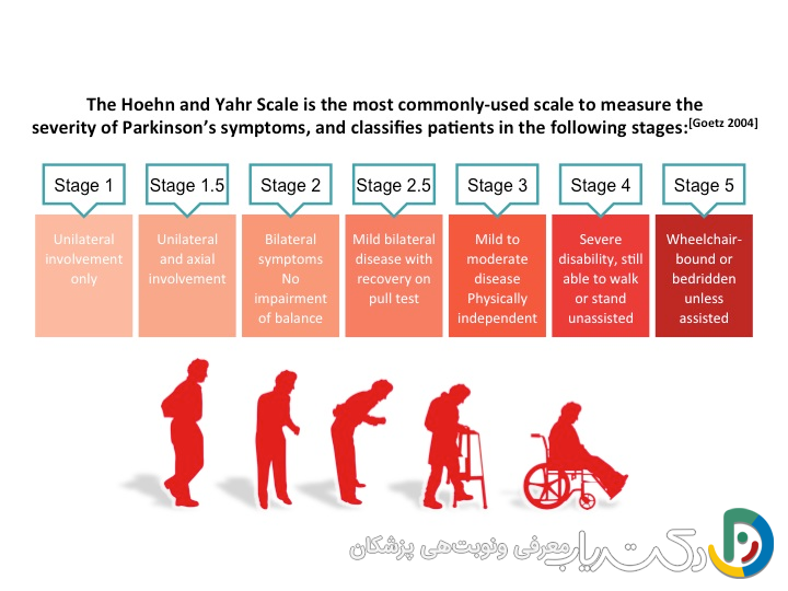 مقیاس هون و یار (Hoehn and Yahr): اصلی‌ترین ابزار مرحله‌بندی پارکینسون