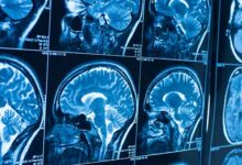 تومورهای مغزی چگونه بوجود می آیند ؟ از یک سلول تا یک توده