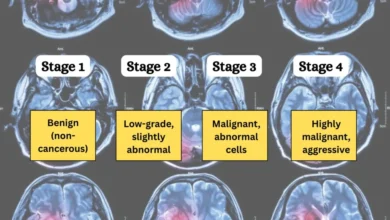تومور مغزی چند گرید دارد ؟ از گرید ۱ تا ۴ به زبان ساده