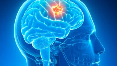 تومورهای مغزی چه علائمی دارند ؟ هرآنچه باید درباره علائم و نشانهها بدانید