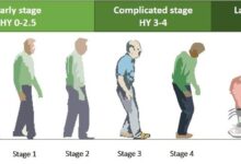 پارکینسون چند مرحله دارد ؟ (راهنمای 5 مرحله Parkinson)