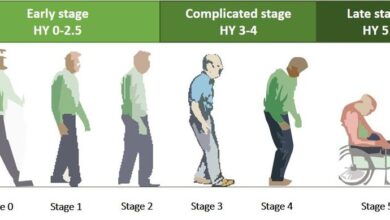 پارکینسون چند مرحله دارد ؟ (راهنمای 5 مرحله Parkinson)