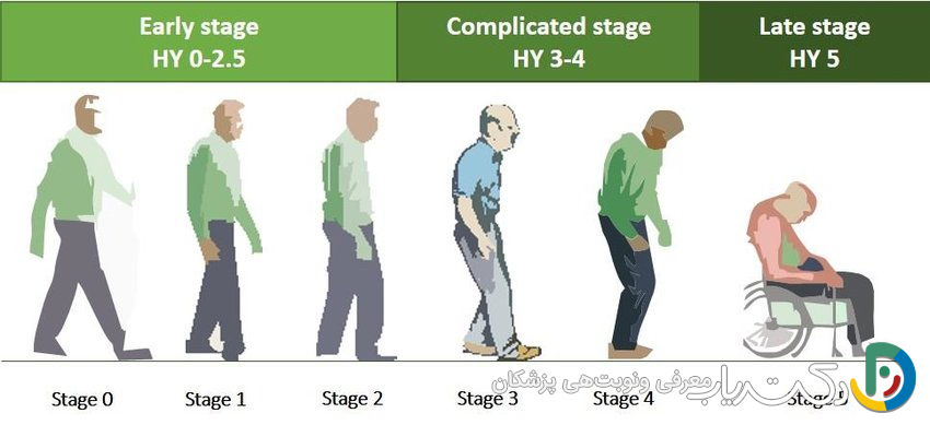 پارکینسون چند مرحله دارد ؟ (راهنمای 5 مرحله Parkinson)