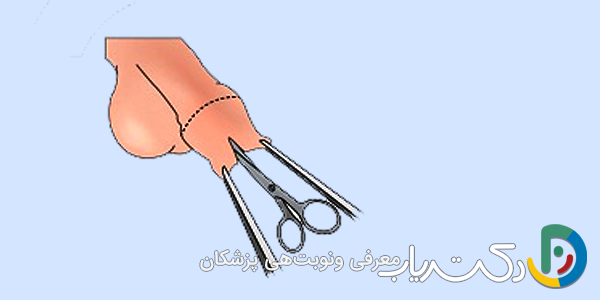 جدا کردن پوست ختنه‌گاه
