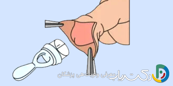 قرار دادن حلقه پلاستیکی