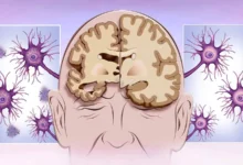 مدت زمان مرحله اخر بیماری آلزایمر چقدر است ؟