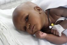 آیا هیدروسفالی کشنده است؟ بررسی کامل