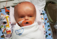 هیدروسفالی جنین چیست و در چند هفتگی مشخص میشود ؟