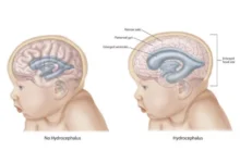 آیا هیدروسفالی ارثی است ؟ بررسی جامع علل ژنتیکی