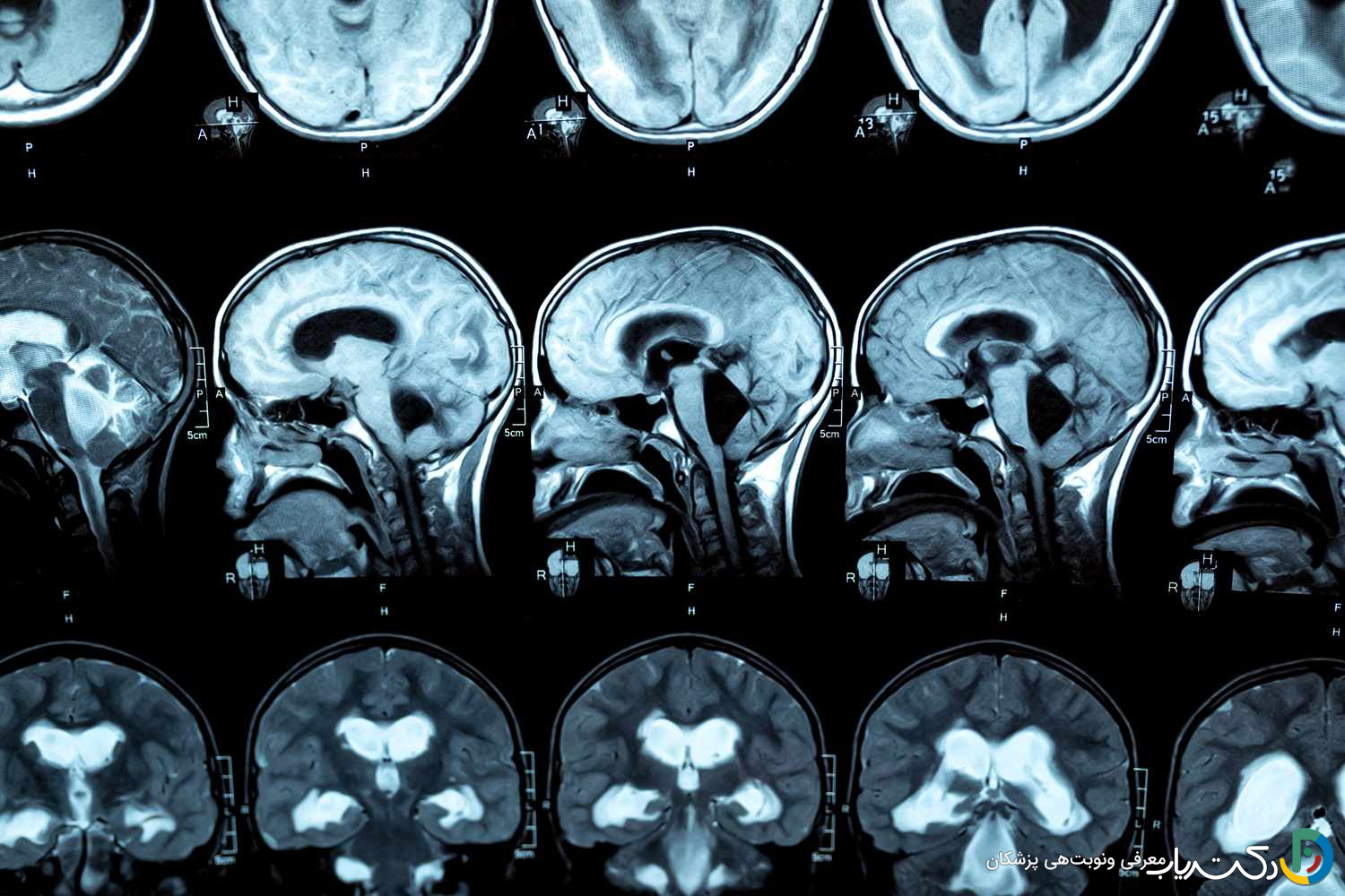 هیدروسفالی چگونه تشخیص داده میشود ؟