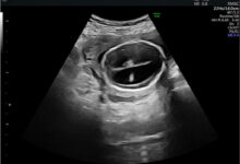 آیا هیدروسفالی در سونوگرافی مشخص میشود ؟