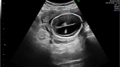 آیا هیدروسفالی در سونوگرافی مشخص میشود ؟