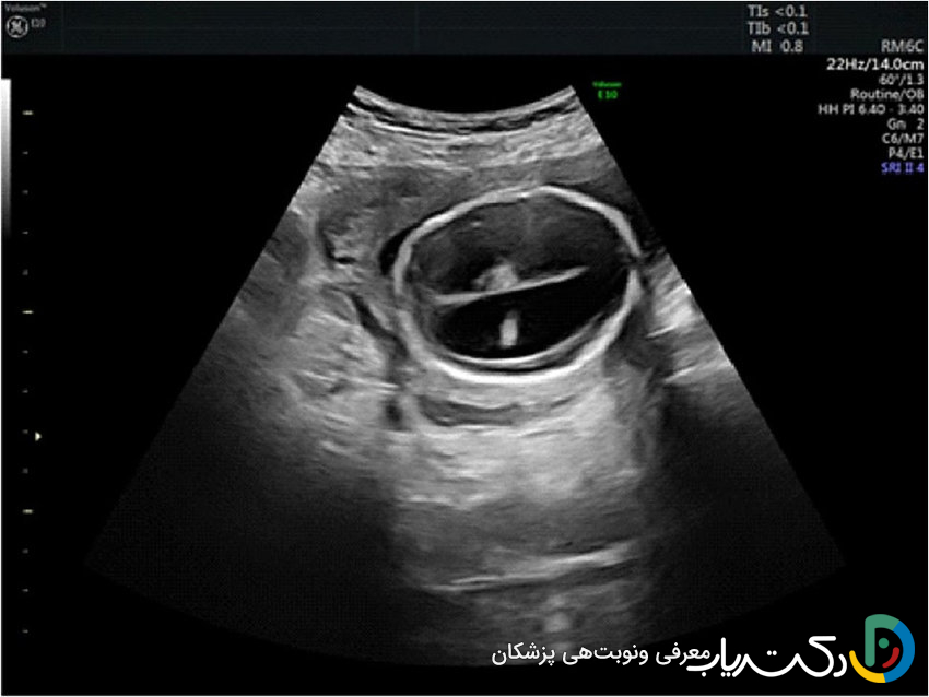 آیا هیدروسفالی در سونوگرافی مشخص میشود ؟