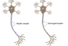 آیا ام اس ارثی است؟ بررسی جامع نقش ژنتیک و عوامل محیطی