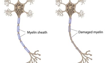آیا ام اس ارثی است؟ بررسی جامع نقش ژنتیک و عوامل محیطی