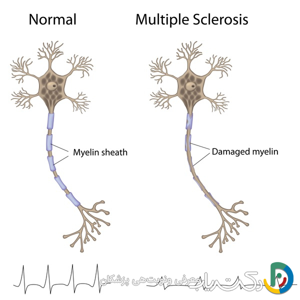 آیا ام اس ارثی است؟ بررسی جامع نقش ژنتیک و عوامل محیطی