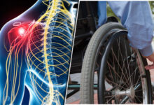 ام اس بعد از چند سال فلج می کند ؟ راهنمای جامع پیشرفت بیماری