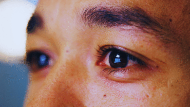 پف زیر چشم نشانه کدام بیماری‌ها است؟