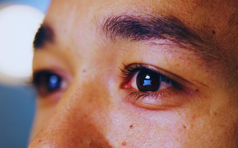 پف زیر چشم نشانه کدام بیماریها است؟