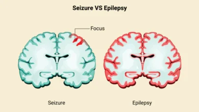 آیا تشنج همان صرع است ؟ هر آنچه که باید بدانید