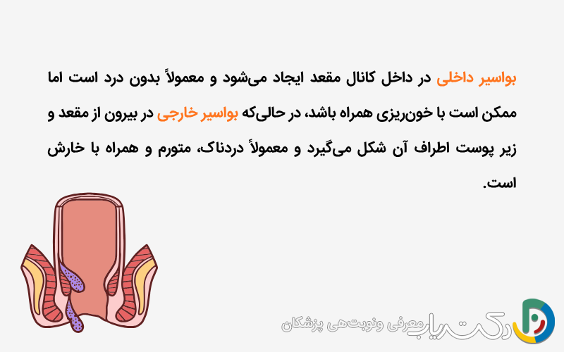 تفاوت بواسیر داخلی و خارجی