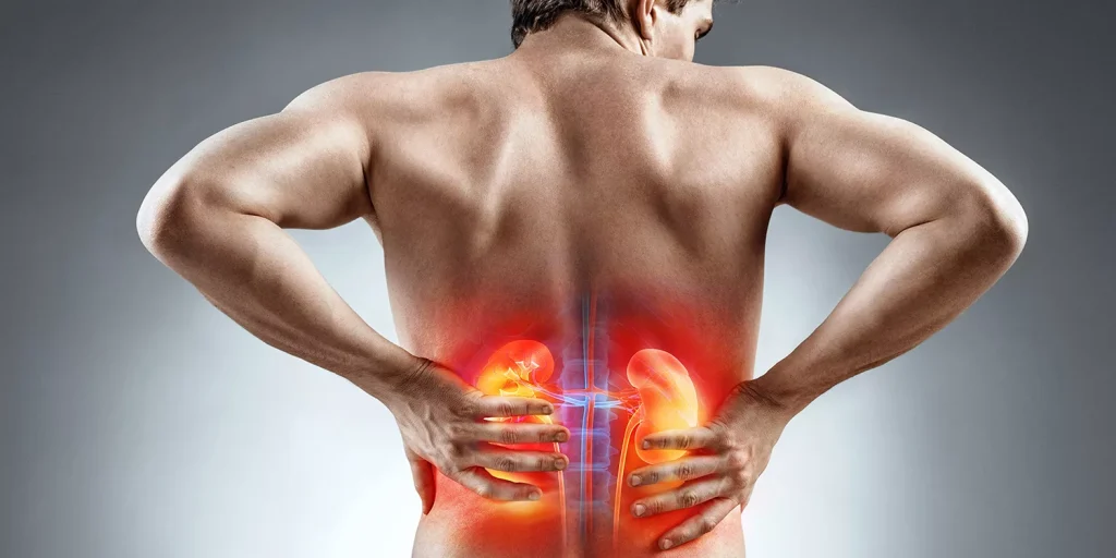 آیا سنگ کلیه باعث کمردرد میشود؟ راهنمای کامل تشخیص و تمایز علائم