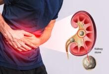 آیا سنگ کلیه باعث حالت تهوع میشود؟ راهنمای کامل علائم و علتها