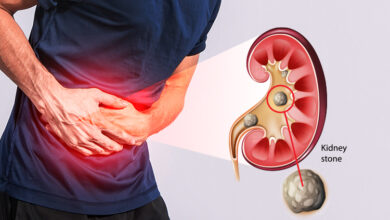 آیا سنگ کلیه باعث حالت تهوع میشود؟ راهنمای کامل علائم و علتها