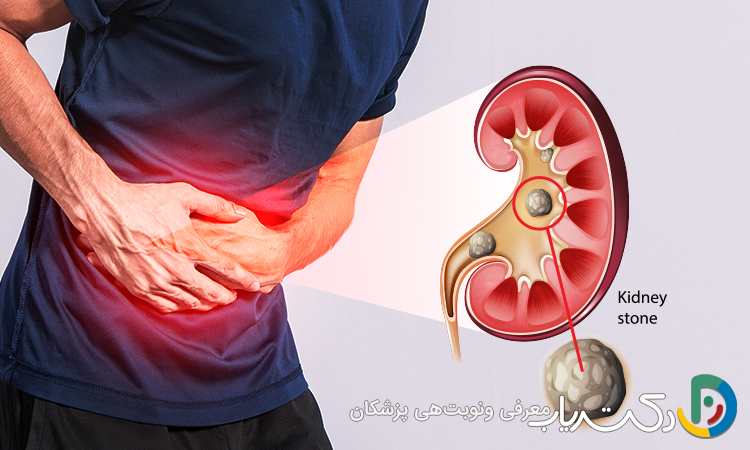 آیا سنگ کلیه باعث حالت تهوع میشود؟ راهنمای کامل علائم و علتها