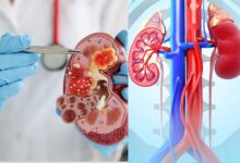 آیا سنگ کلیه در مردان باعث ناباروری میشود؟ بررسی علمی و جامع