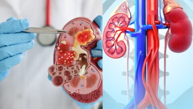 آیا سنگ کلیه در مردان باعث ناباروری میشود؟ بررسی علمی و جامع