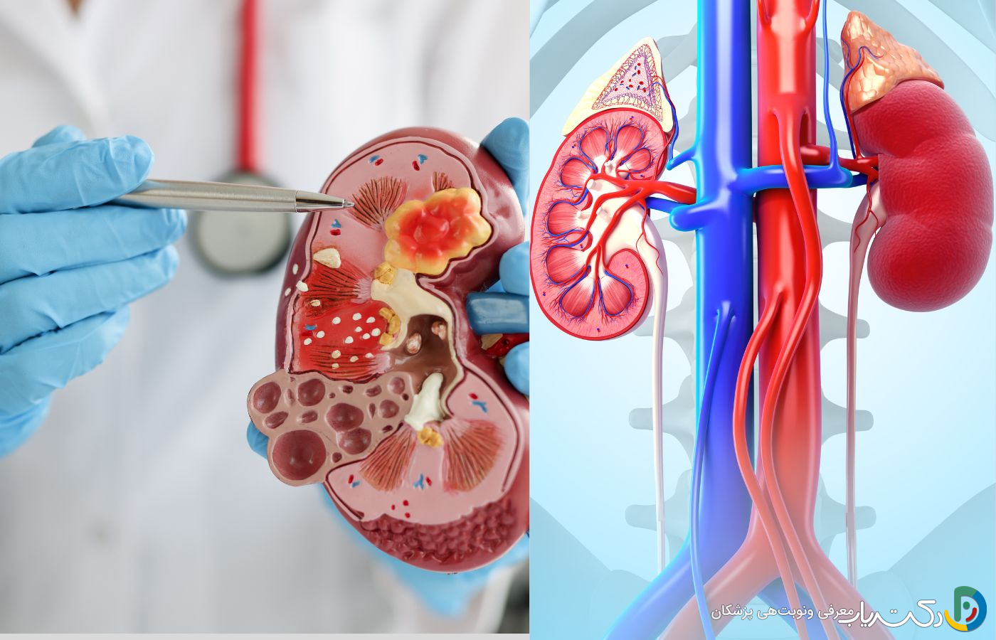 آیا سنگ کلیه در مردان باعث ناباروری میشود؟ بررسی علمی و جامع