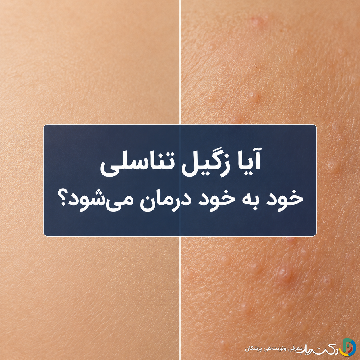 آیا زگیل تناسلی خود به خود درمان میشود؟